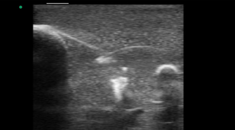 Wireless Ultrasound for تدريب على الثدي