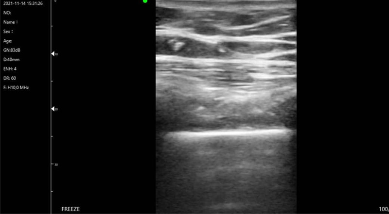 Wireless Ultrasound for C10T الرئة