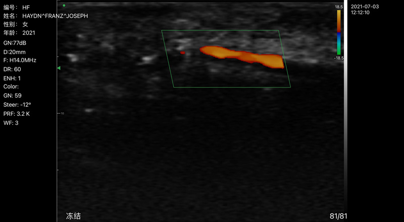 Wireless Ultrasound for شريان الإصبع