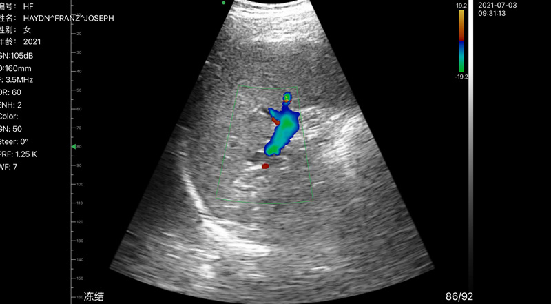 Wireless Ultrasound for الطحال