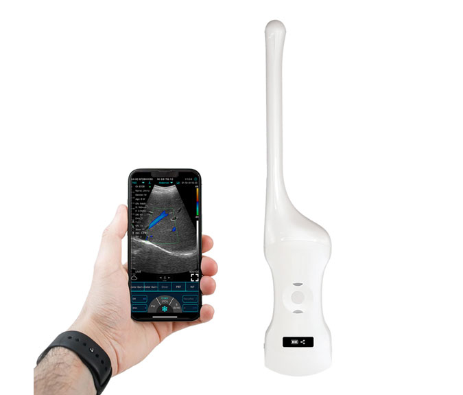 mobile phone ultrasound